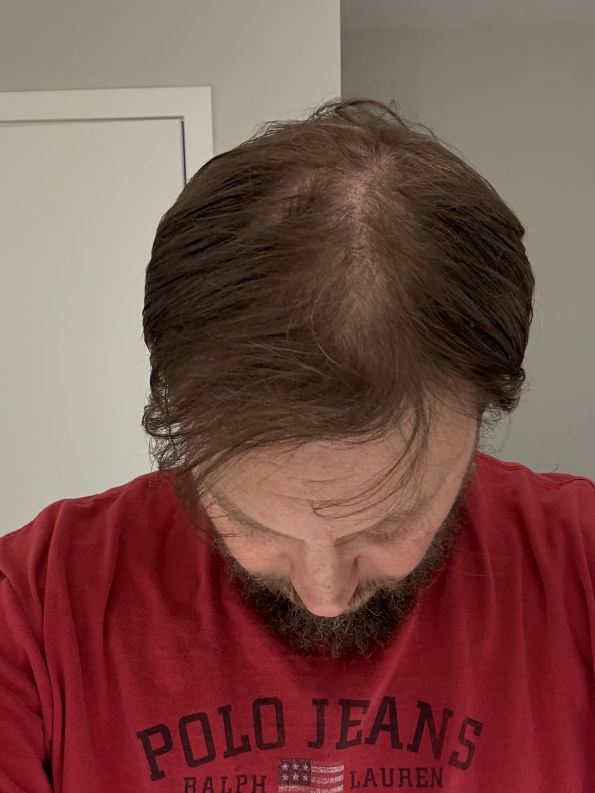 Theradome PRO Laser Hair Growth Helmet LH80 - 100% Laser, No Ineffective LEDs - FDA-Cleared Red Light Therapy for Hair Regrowth 2x Week - Made in the USA customer photo 2