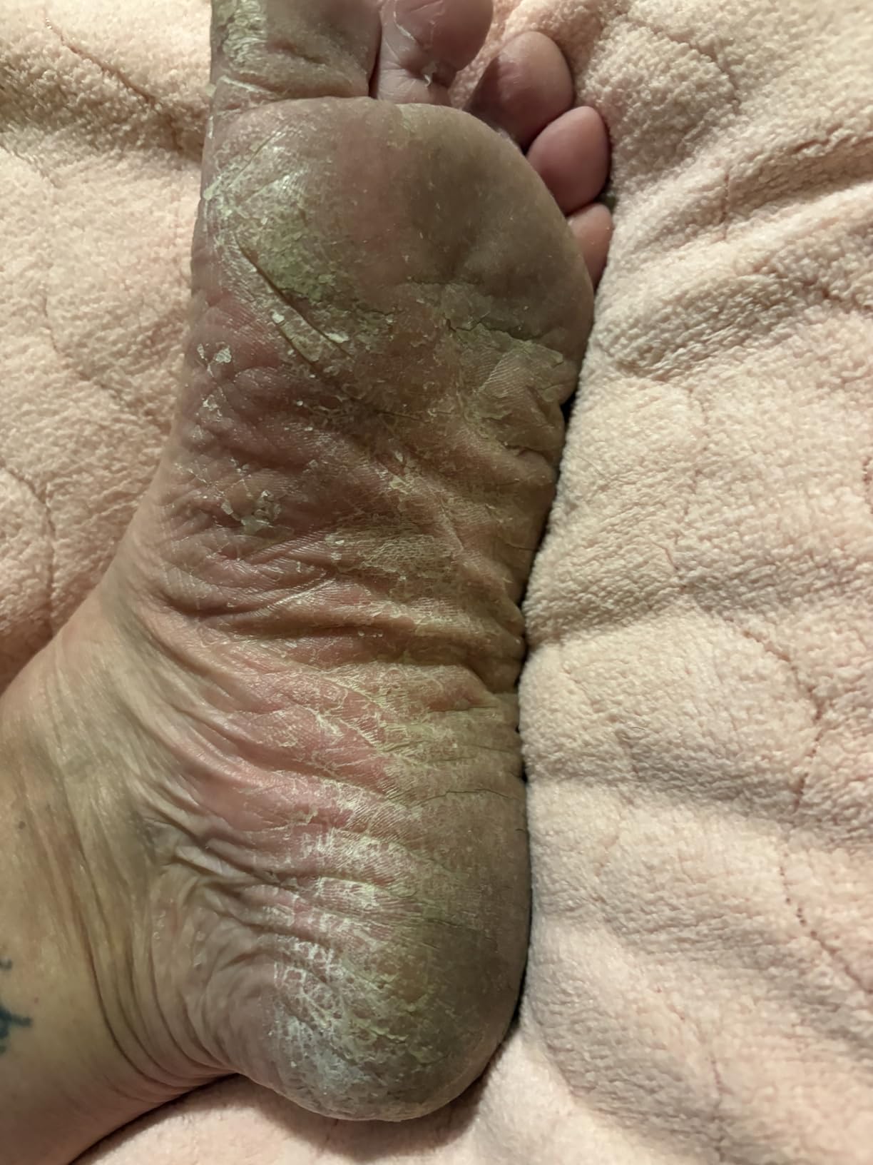 Lavinso Foot Peel Mask for Dry Cracked Feet - 2 Pack Peeling Mask Removes Dead Skin and Calluses - Exfoliating for Soft Baby Feet, Original Scent customer photo 1